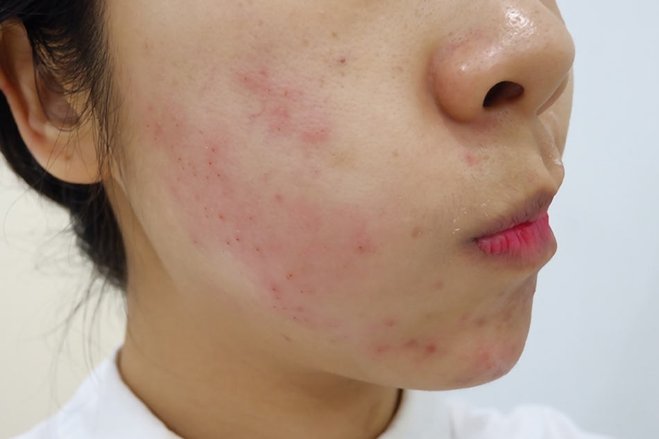 รักษาสิวอุดตัน