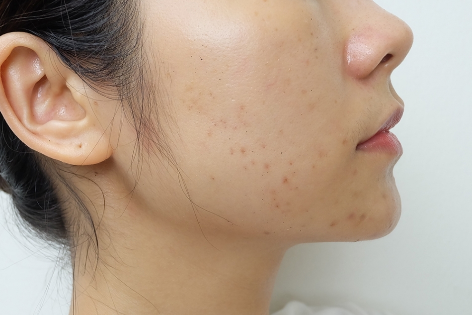 รักษาสิวอุุดนต้น