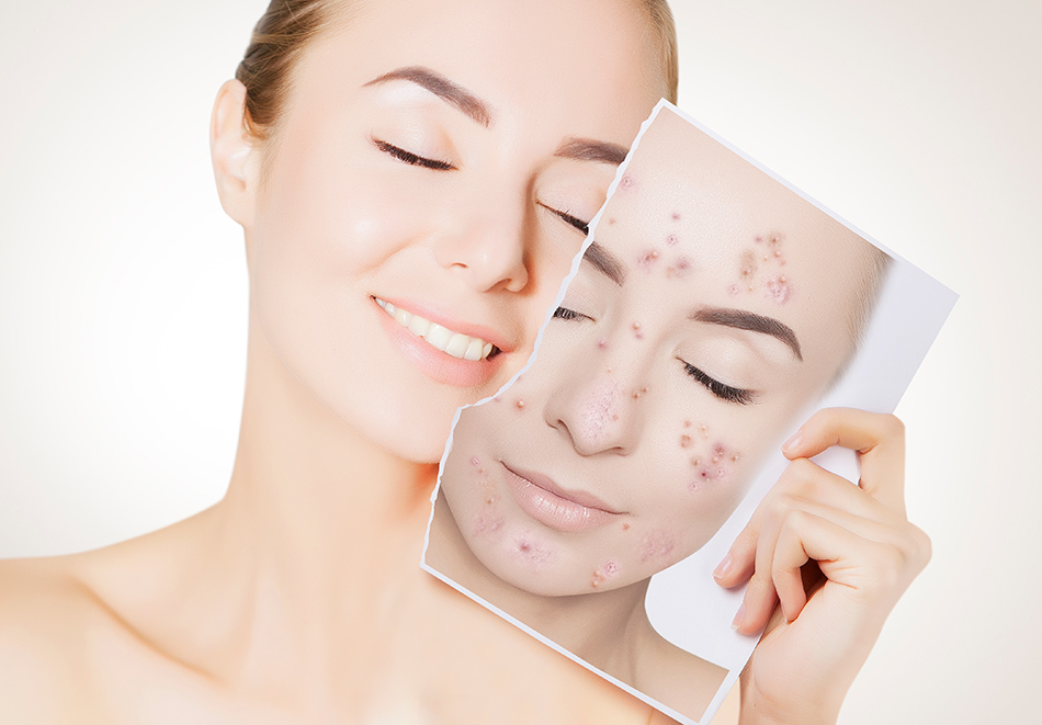 ราชเทวีคลินิก FIA and Acne AI Tracker โปรแกรมติดตามสิว