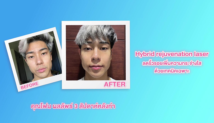 Review-Unlock-Hybrid-Rejuvenation-Laser-before-after.jpg
