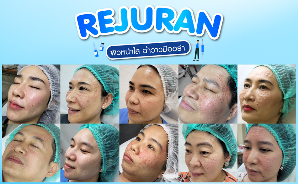 รีวิว Rejuran ฉีดผิวหน้าฉ่ำวาว สไตล์เกาหลี - ราชเทวีคลินิก