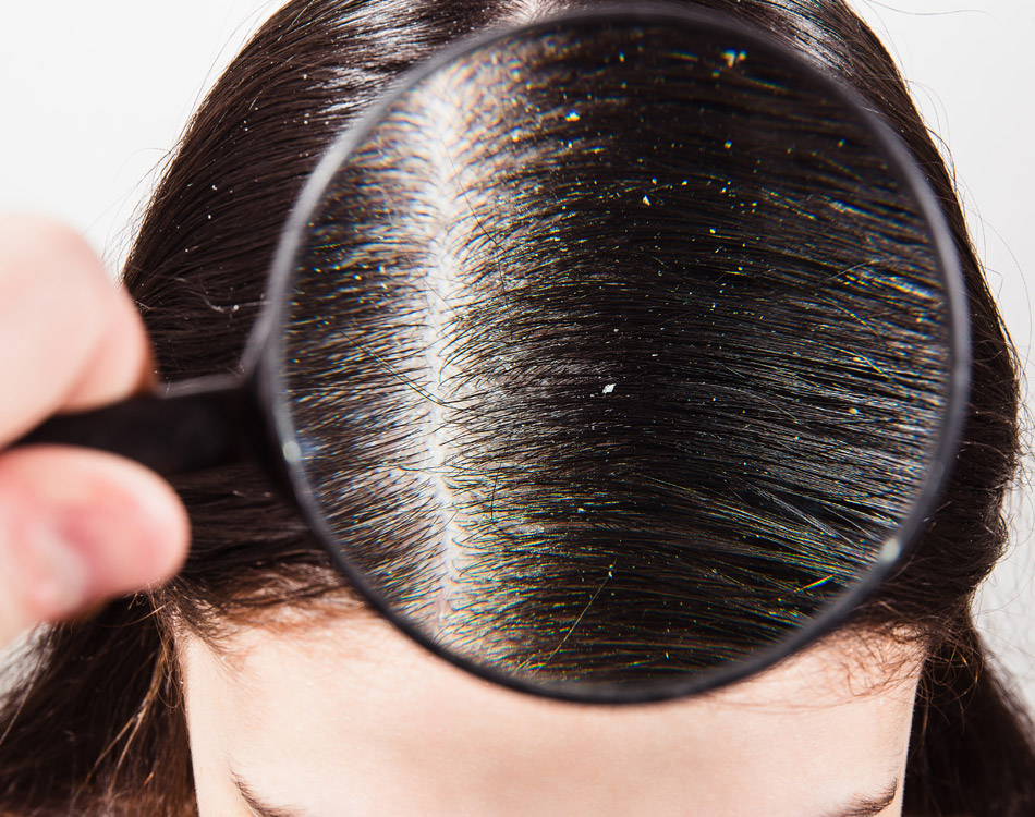 Article Dandruff รังแคบนหนังศีรษะ