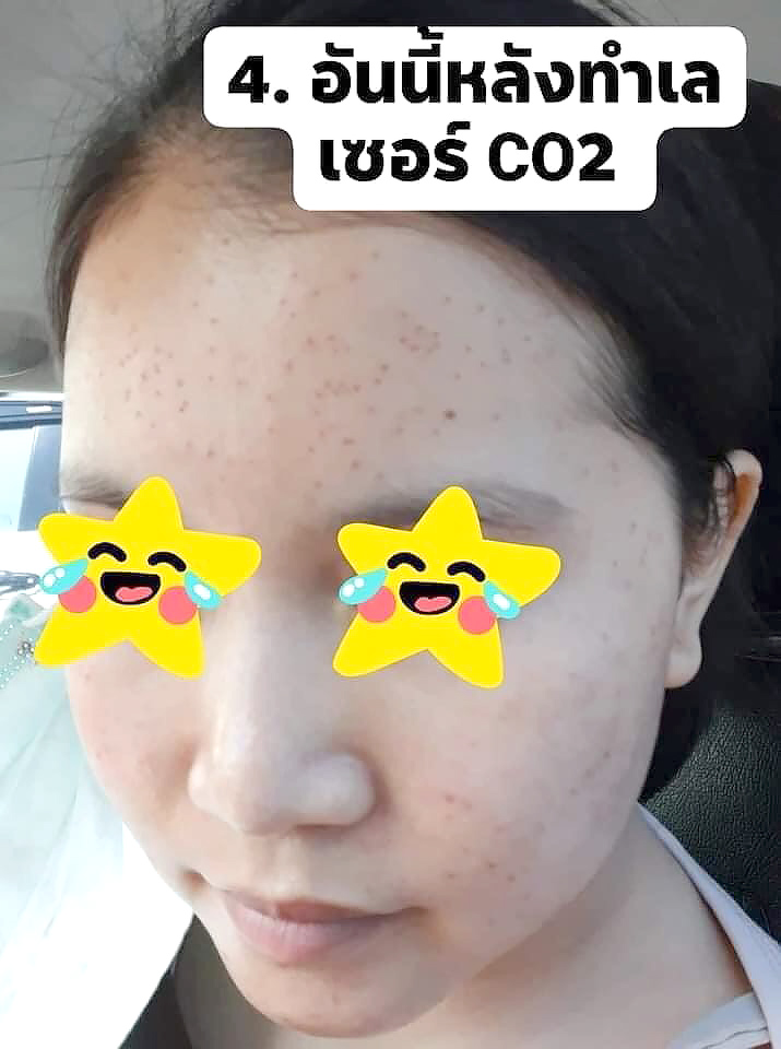 Review-Acne-Tsp-05.JPG