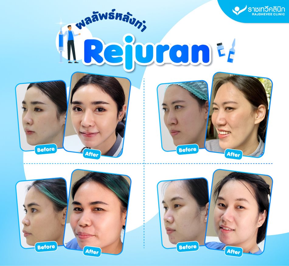 รีวิว Rejuran ฉีดผิวหน้าฉ่ำวาว สไตล์เกาหลี - ราชเทวีคลินิก